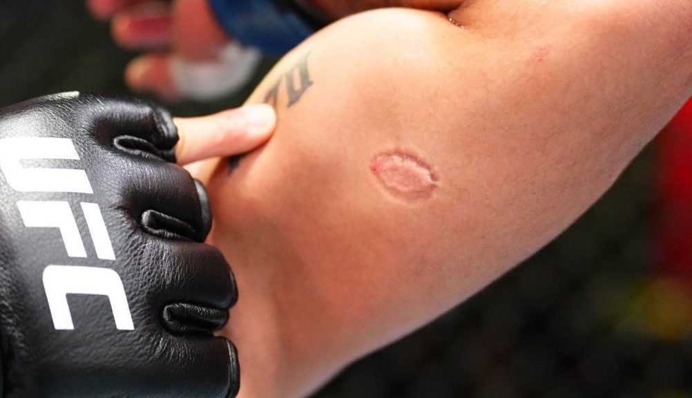 UFC Vegas 89: El luchador brasileño André Lima recibe un bono de 50.000 dólares tras haber sido mordido