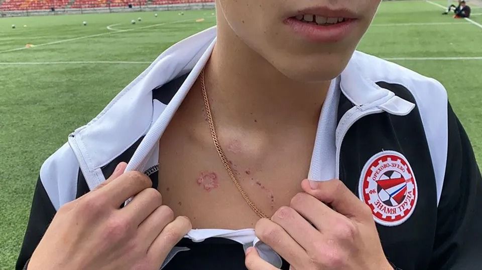 Russian Footballer Reveals How He Survived a Lightning Strike on the Field